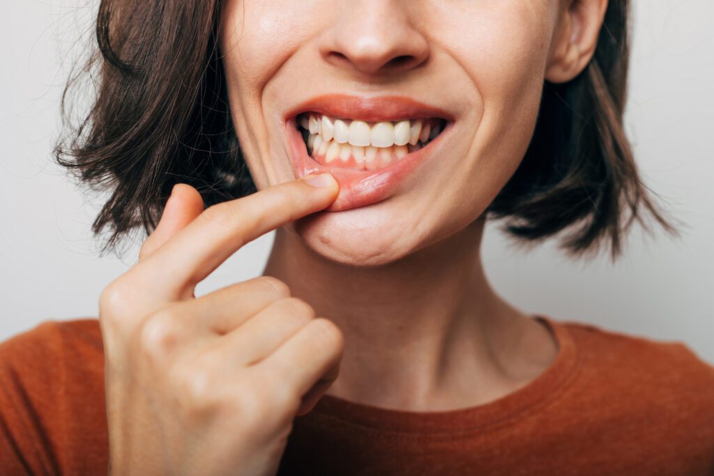 Periodontitis and Gum Disease
